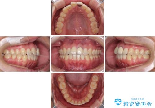 前歯の歯並びとクラウンを改善 インビザラインとオールセラミックの治療中