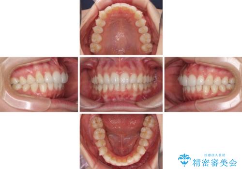 矯正治療の後戻りをインビザライン・ライトで改善の治療中