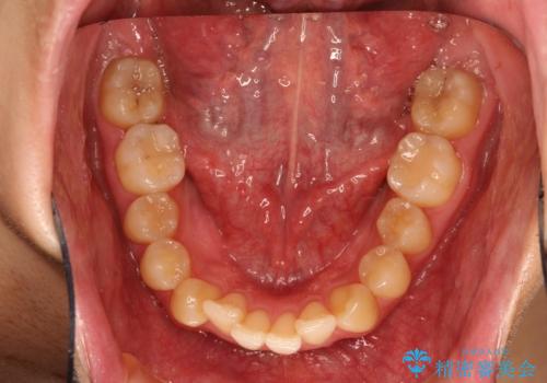 前歯の凸凹をきれいにしたい。インビザラインによる治療の治療前