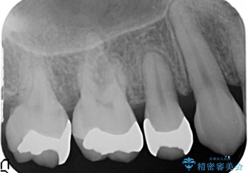 笑ったら銀歯が見える。 セラミックインレーによる治療の治療前
