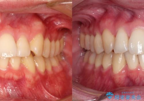 前歯の凸凹をきれいにしたい。インビザラインによる治療