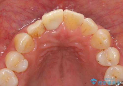 前歯 インプラントによる欠損補綴の治療後