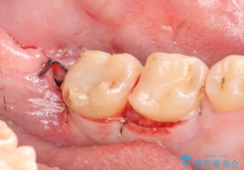 歯冠長延長術を併用した審美的セラミック治療の治療後