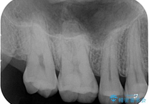 米国で笑われた 保険のつめものをやり直すの治療後