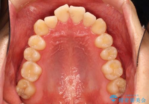 前歯の凸凹をきれいにしたい。インビザラインによる治療の治療前