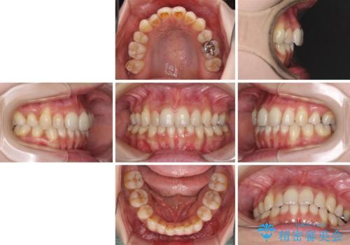 軽度な歯列不正 インビザライン・ライトによる矯正治療の治療前