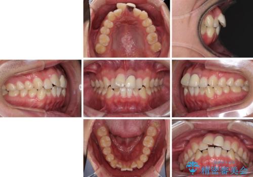 前歯の歯並びとクラウンを改善 インビザラインとオールセラミックの治療前