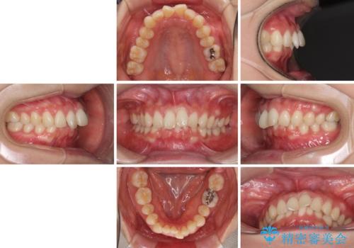 インビザラインによるディープバイトの改善の治療前