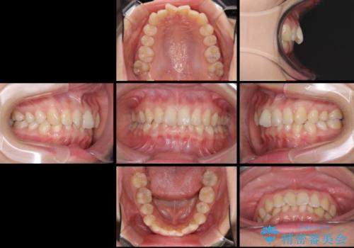 インビザラインによる前歯の矯正治療の治療前