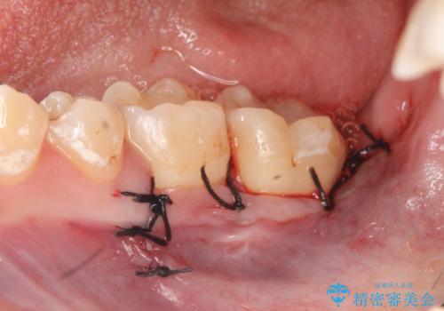 歯冠長延長術を併用した審美的セラミック治療の治療後