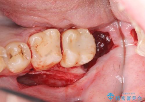 歯冠長延長術を併用した審美的セラミック治療の治療中
