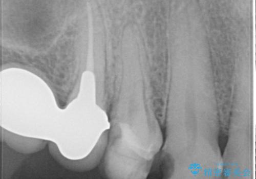 拡大鏡にて虫歯を除去。精度の高いセラミッククラウンの治療前