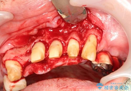 歯周病におかされた前歯の再建治療の治療中