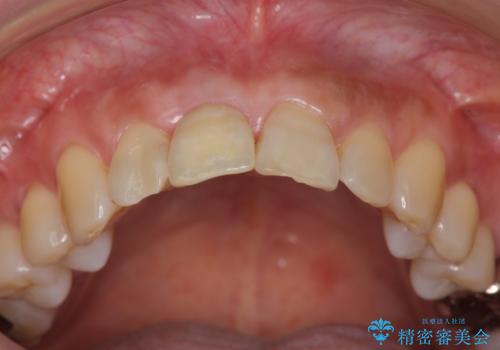 前歯　インプラントによる欠損補綴の治療後