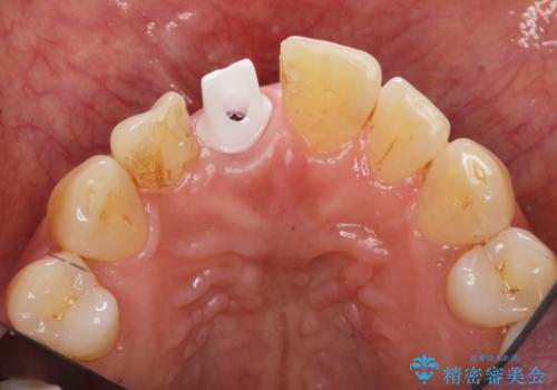 前歯 インプラントによる欠損補綴の治療中