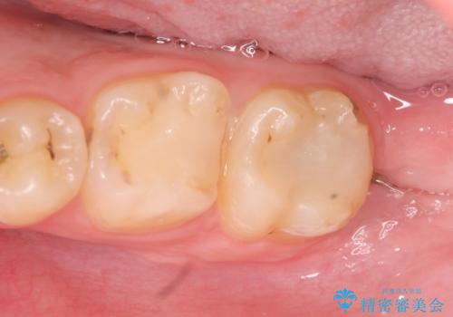 歯冠長延長術を併用した審美的セラミック治療の治療前