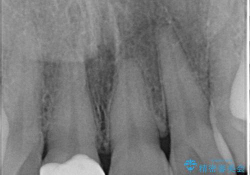 昔ぶつけた前歯 つめもの変色の治療後