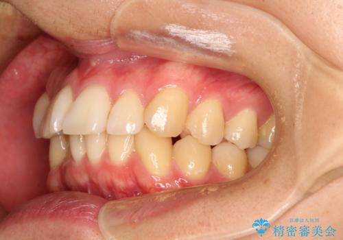 前歯の凸凹をきれいにしたい。インビザラインによる治療の治療前