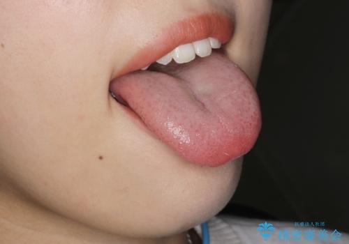 [舌小帯形成術]  舌が短く 話しづらい 　の治療後