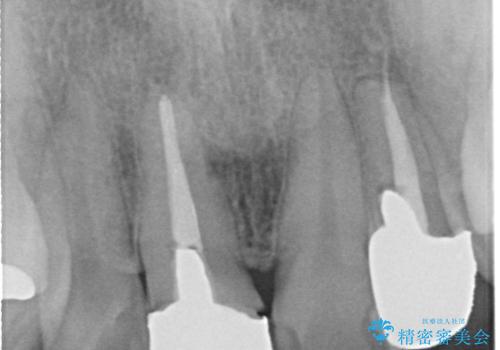 不自然な保険のかぶせ物をセラミックで自然な前歯への治療前