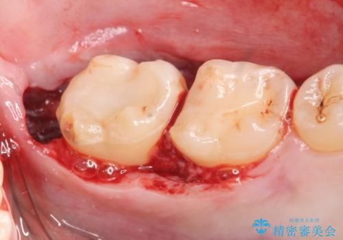 歯冠長延長術を併用した審美的セラミック治療の治療中