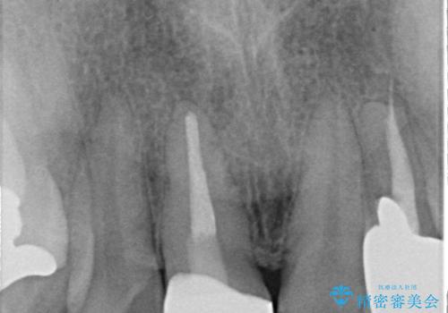 不自然な保険のかぶせ物をセラミックで自然な前歯への治療後