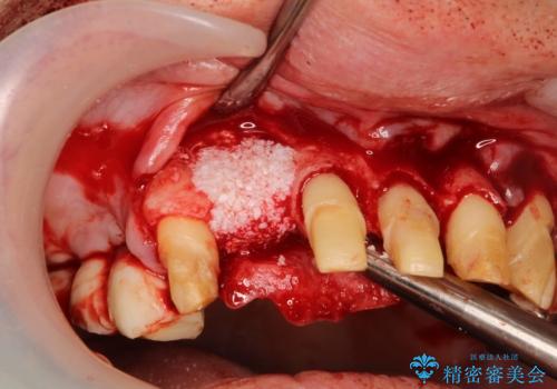 歯周病におかされた前歯の再建治療の治療中