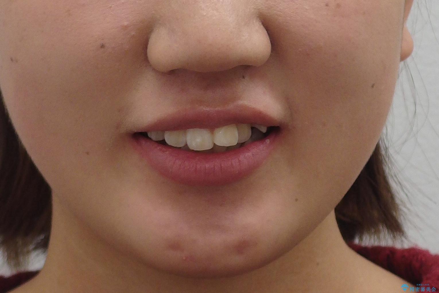 成人式に間に合う　前歯の矯正の治療前（顔貌）