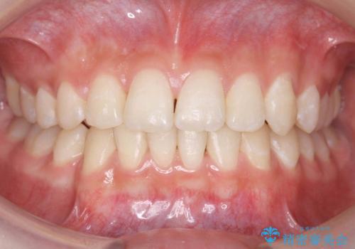 埋まっている犬歯を抜歯して、歯列矯正の症例 治療後