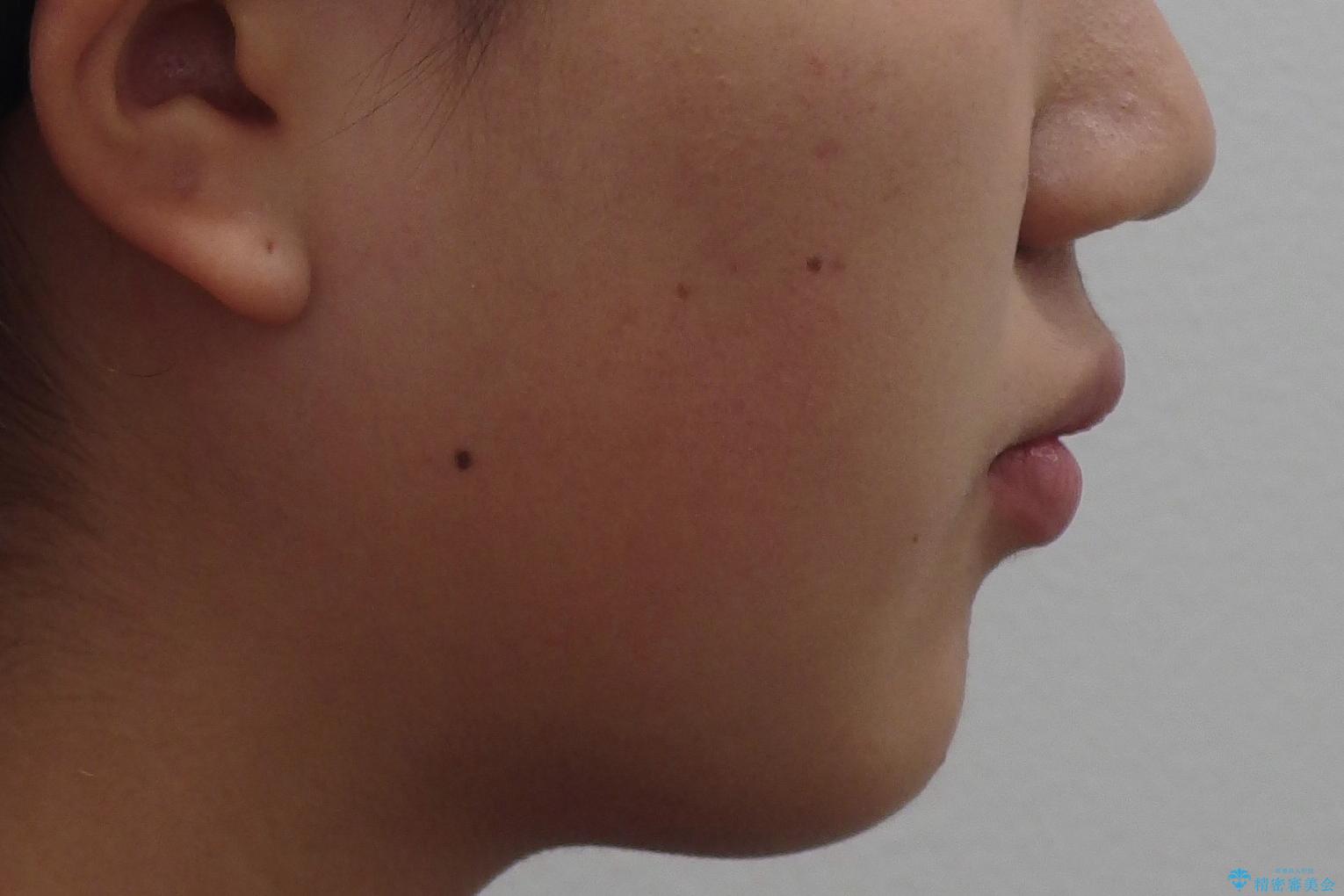 成人式に間に合う 前歯の矯正の治療前(顔貌)