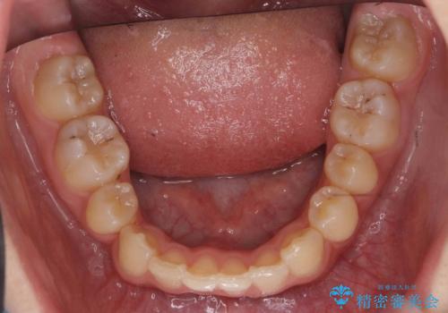 埋まっている犬歯を抜歯して、歯列矯正の治療後