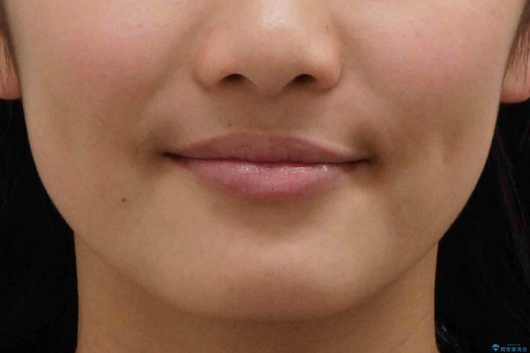 埋まっている犬歯を抜歯して、歯列矯正の治療後(顔貌)