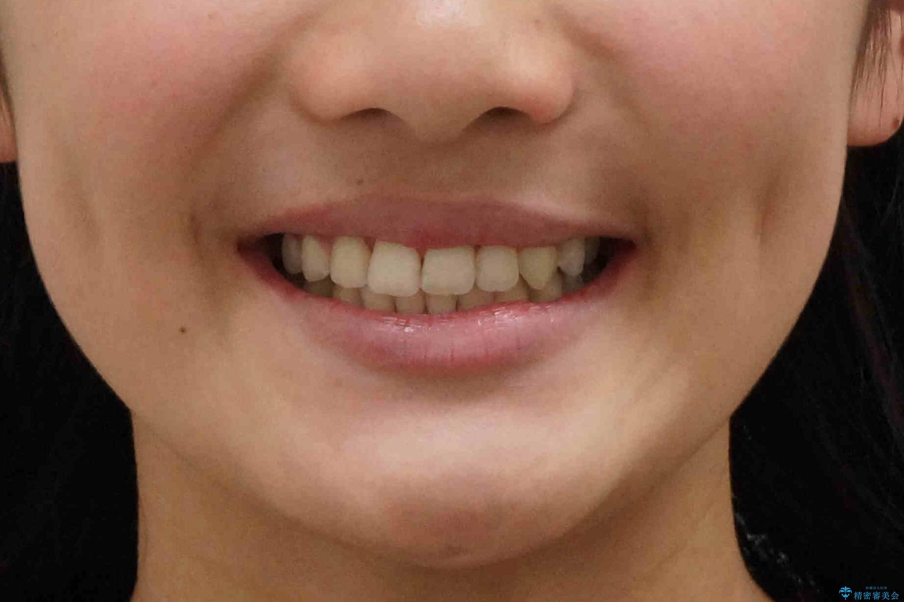 埋まっている犬歯を抜歯して、歯列矯正の治療後(顔貌)