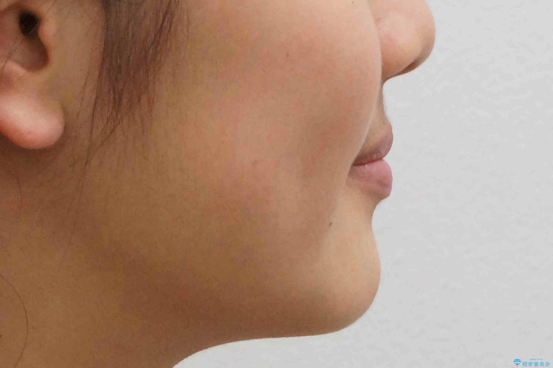 埋まっている犬歯を抜歯して、歯列矯正の治療後(顔貌)