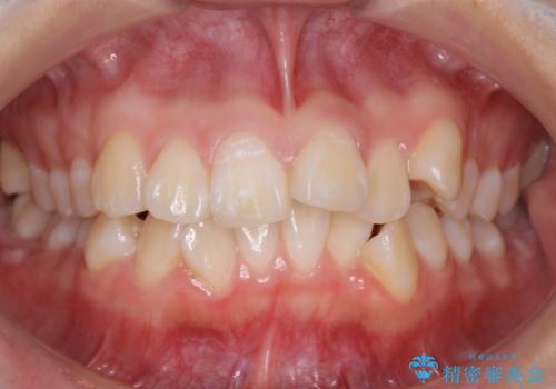 成人式に間に合う　前歯の矯正の症例 治療前