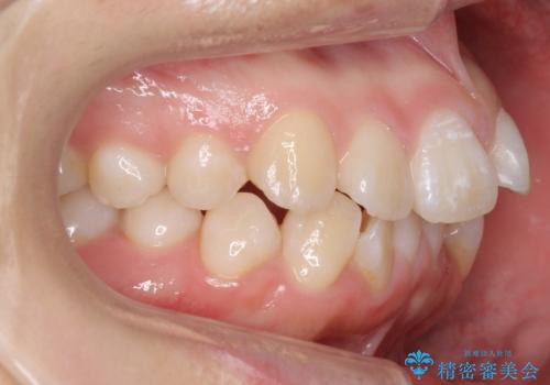 成人式に間に合う 前歯の矯正の治療前