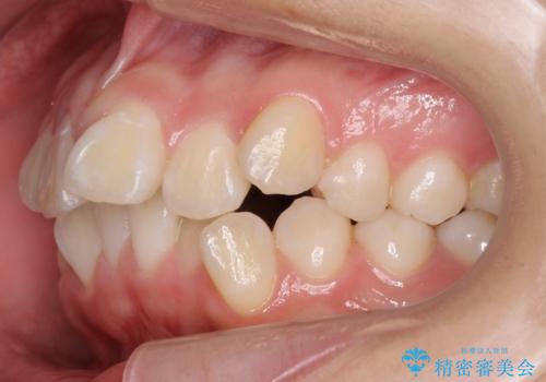 成人式に間に合う 前歯の矯正の治療前