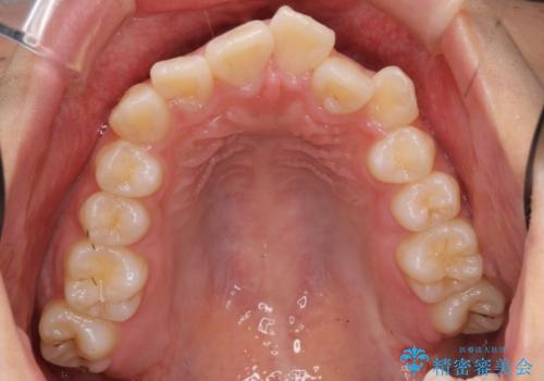成人式に間に合う　前歯の矯正の治療前