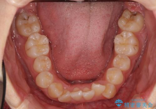 成人式に間に合う　前歯の矯正の治療前