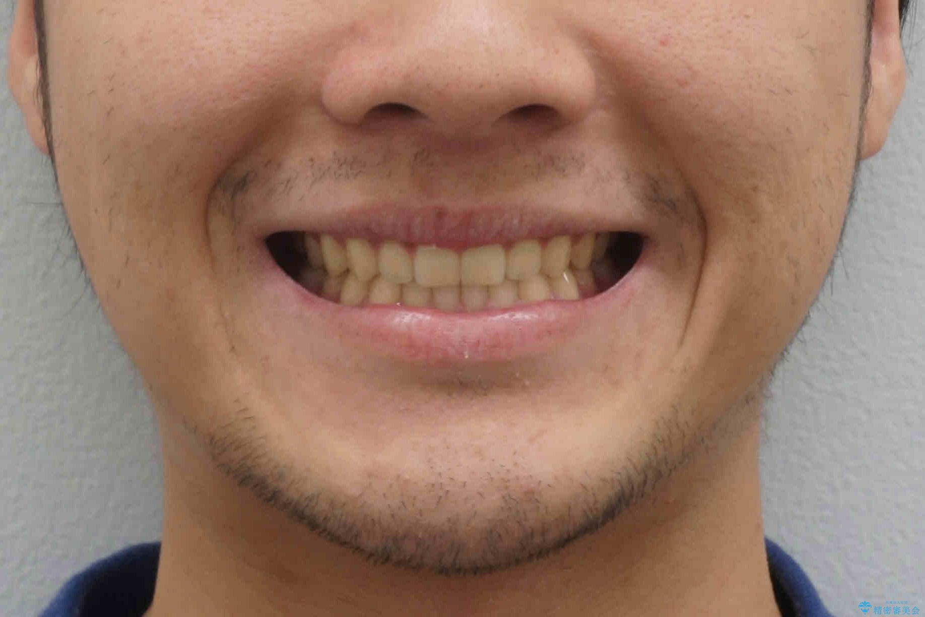 前歯のすきま　受け口　インビザラインでの治療後（顔貌）