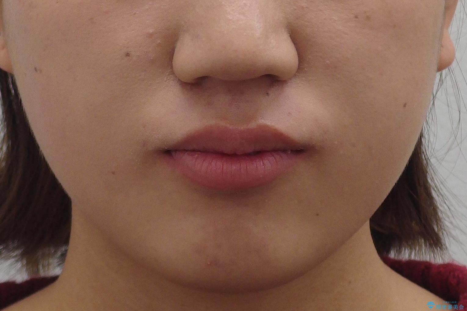 成人式に間に合う 前歯の矯正の治療前(顔貌)