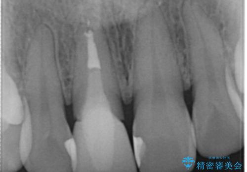差し歯をもっと自然に 30代女性の治療前