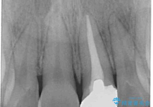 前歯の歯並びとクラウンを改善 インビザラインとオールセラミックの治療前