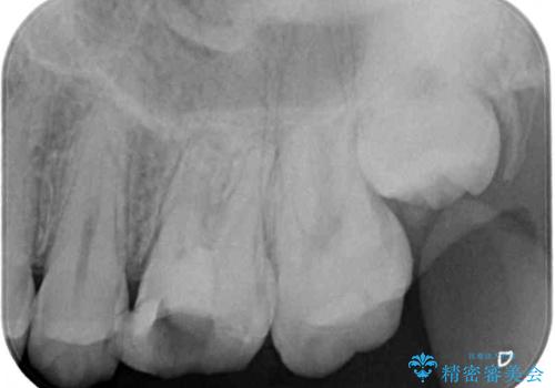 根管治療中の転院　奥歯のオールセラミック治療の治療前