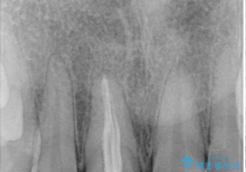 ぶつけて変色した前歯 オーダーメイドタイプのオールセラミッククラウンの治療前