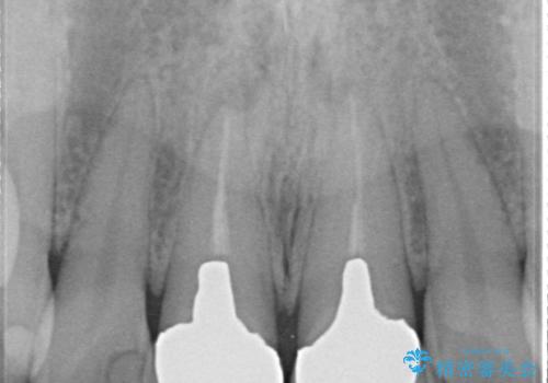 前歯の根元が黒い オールセラミッククラウンの装着による改善の治療前