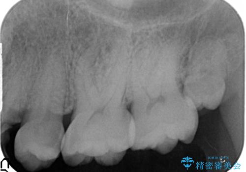 大きな虫歯で崩壊した歯の修復の治療前