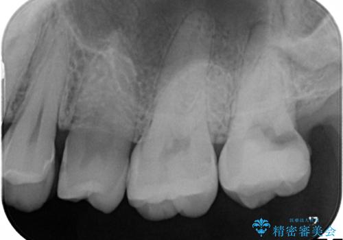 奥歯が痛い! 中途半端な治療をしっかりとやり治すの治療前