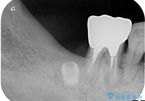 歯周病にて保存不可能な歯をショートインプラントで回復するの治療中