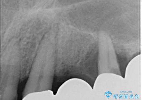 歯周病におかされた前歯の再建治療の治療前